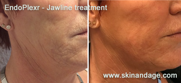 EndoPlexr kaaklijnbehandeling – resultaat na 4 weken