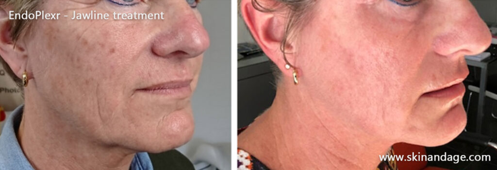 EndoPlexr- kaaklijn behandeling – resultaat na 6 weken
