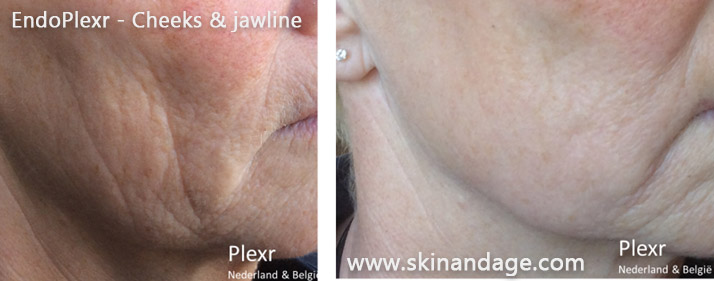 EndoPlexr kaaklijnbehandeling – resultaat na 5 weken