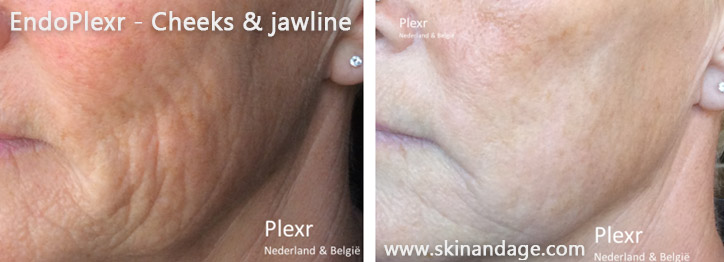 EndoPlexr kaaklijnbehandeling – resultaat na 5 weken