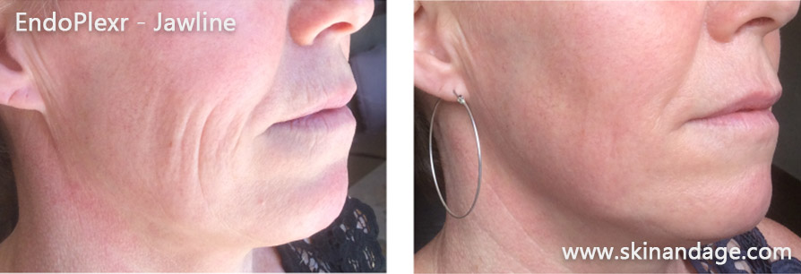 EndoPlexr kaaklijnbehandeling – resultaat na 5 weken