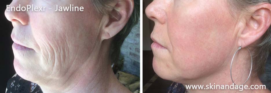 EndoPlexr kaaklijnbehandeling – resultaat na 5 weken